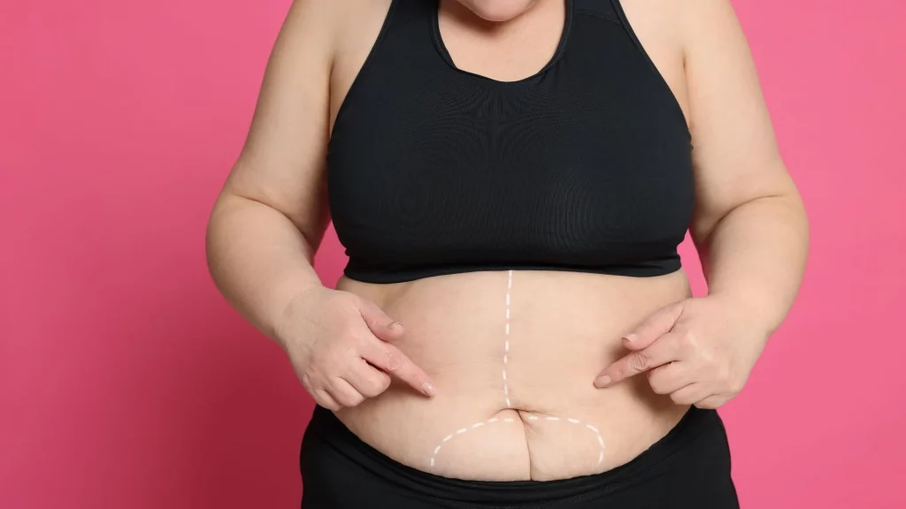 ISEIE-que es nutrición bariátrica