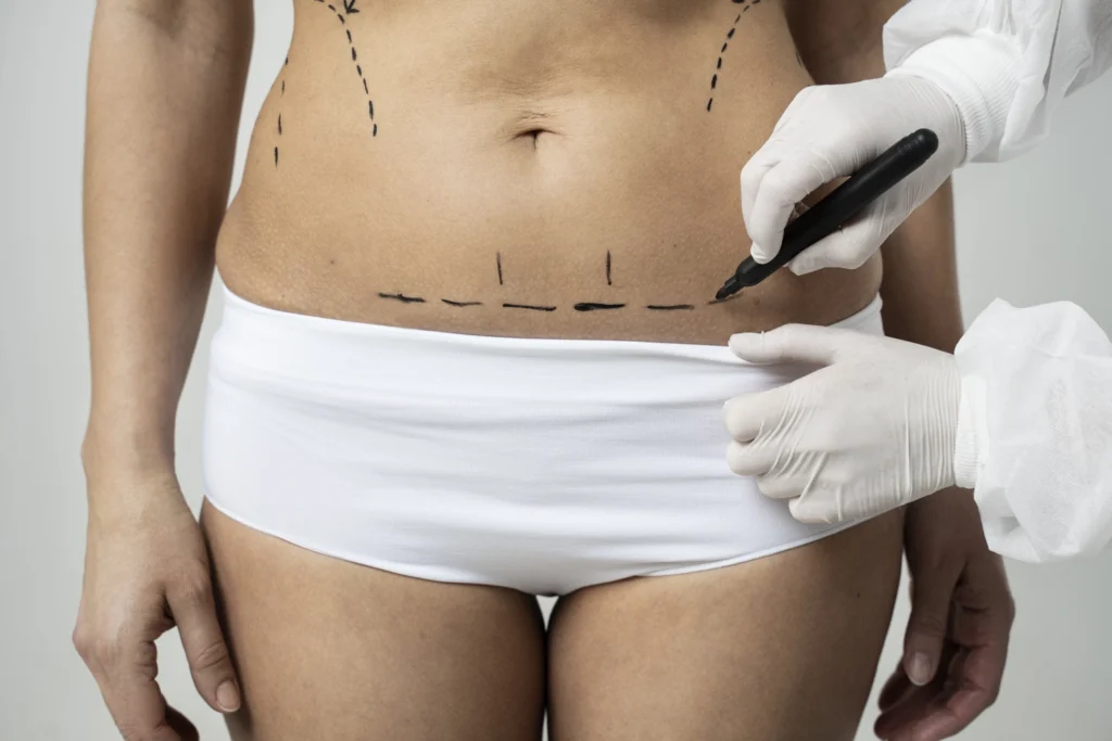 Maestría en Abdominoplastia y Cirugía Postbariátrica 1