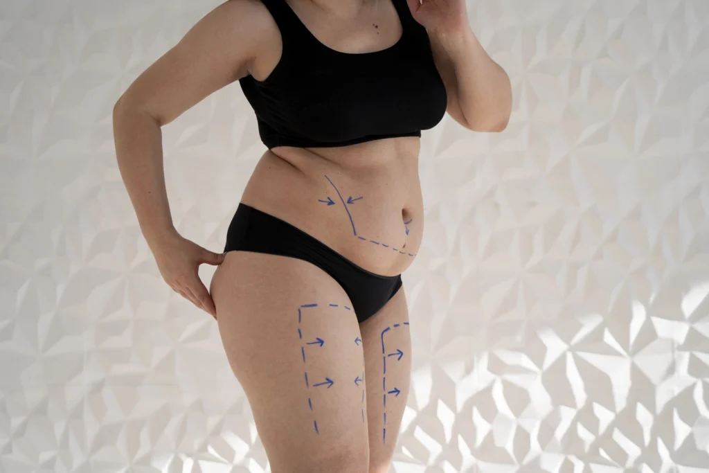Maestría en Cirugía de Contorno Corporal Liposucción Lipo HD y Lipoescultura 1