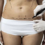 Maestría en Abdominoplastia y Cirugía Postbariátrica 1